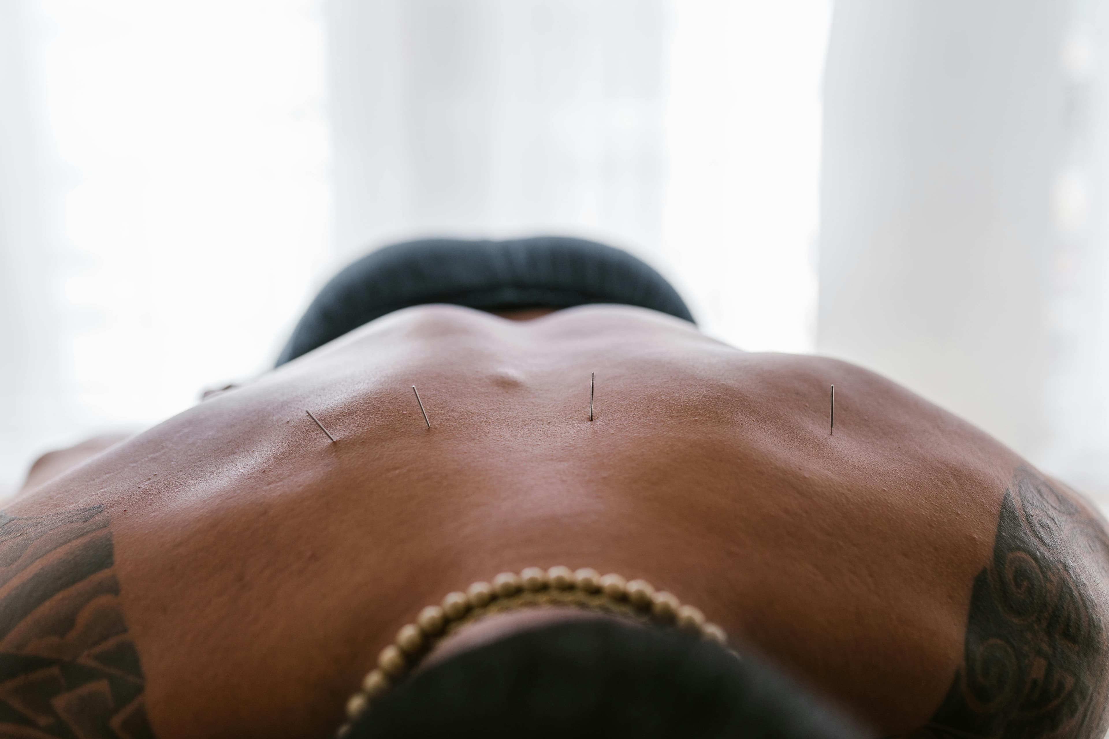Dry needling performed on shoulder muscles